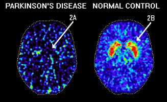 Εγκεφαλογράφημα ασθενών με Πάρκινσον